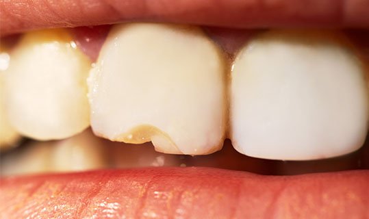 causes of broken tooth belmont wa