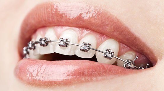 dental braces belmont wa