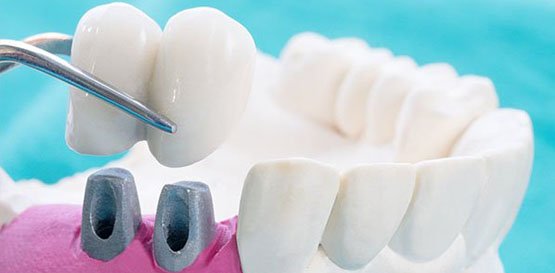 dental crowns belmont wa