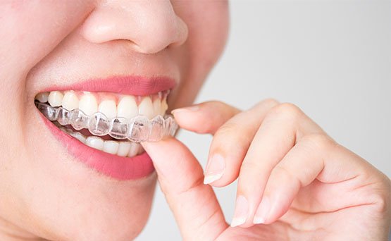 invisalign belmont wa