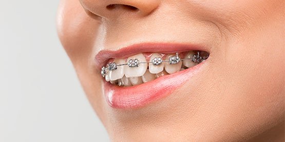 orthodontics Belmont WA