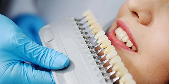 affordable dental veneers belmont wa