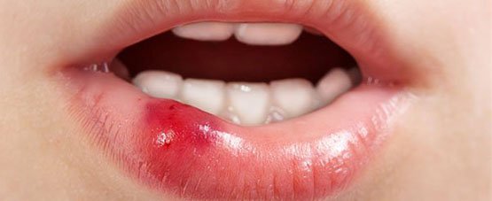 soft tissues injuries in the mouth belmont wa