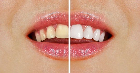 teeth whitening belmont wa