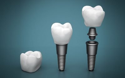 Top 8 Reasons Dental Implants are Long-Term Solutions to Missing Teeth