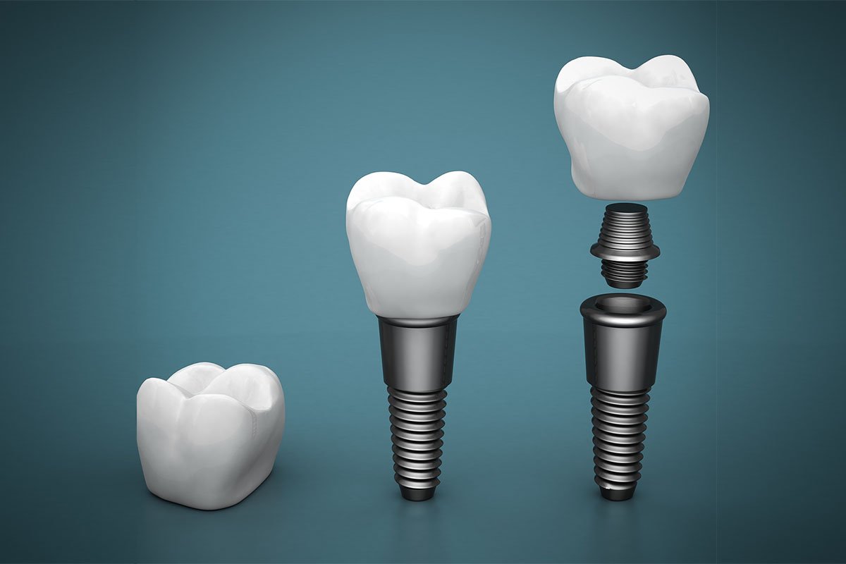 top 8 reasons dental implants are long-term solutions to missing teeth