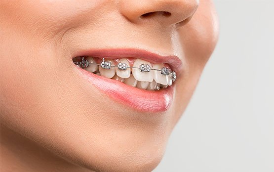 affordable dental braces belmont wa