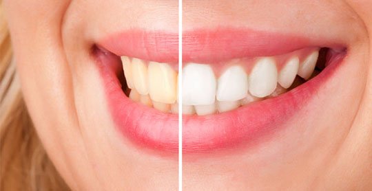 tooth whitening belmont wa