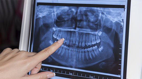 preparation for dental x-rays