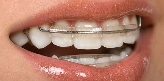 benefit of retainers belmont wa