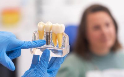 Dental Implants Belmont WA: 8 Long-Term Benefits for Missing Teeth