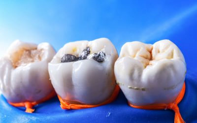 Choosing the Best Dental Fillings in Belmont WA