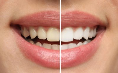 Considering Teeth Whitening? Here Are Some Considerations