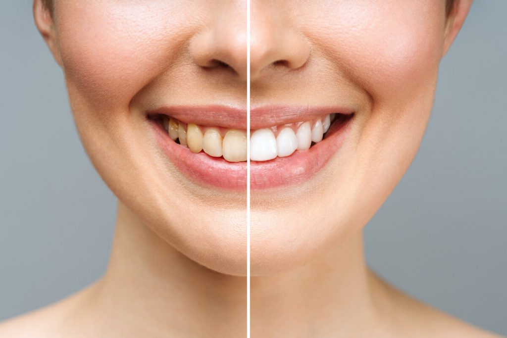 considering tooth whitening here are some considerations