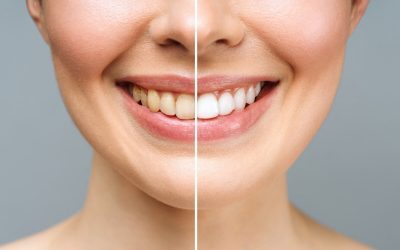 Considering Tooth Whitening? Here Are Some Considerations