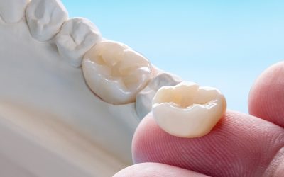 How Long Will Dental Crowns Last?