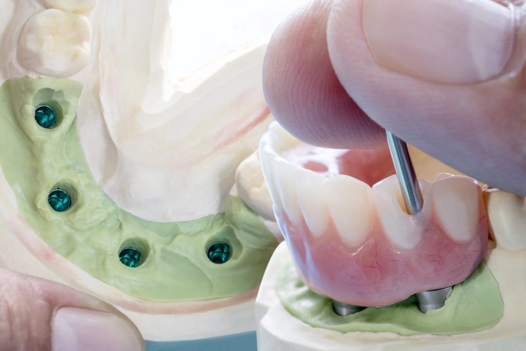 all-on-4 or traditional dental implants epsom dental care