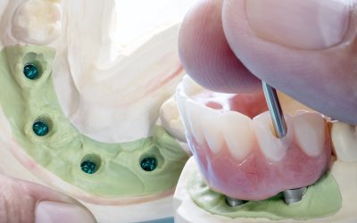 Which is Perfect for You: All-on-4 or Traditional Dental Implants?
