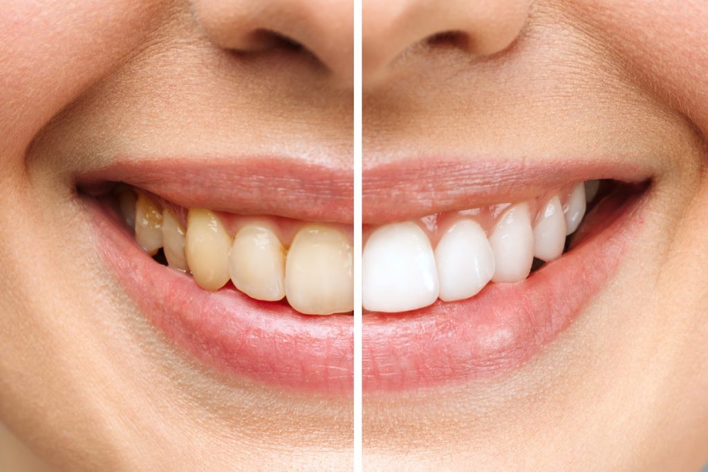 transforming your smile with professional teeth whitening