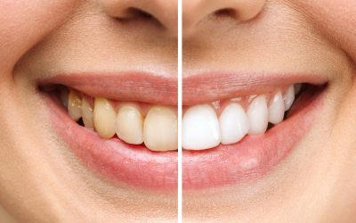 Shine On: Transforming Your Smile with Professional Teeth Whitening