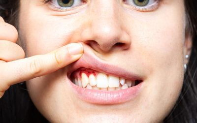 Gum Disease and Tooth Loss – Understanding the Connection and How to Stop It