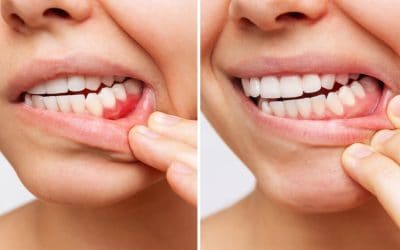 Gum Disease Treatment in Belmont WA: Early Signs and Solutions