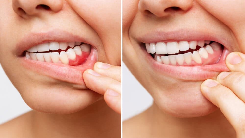 Comparison of healthy gums and inflamed gums showing early signs of gum disease in Belmont WA
