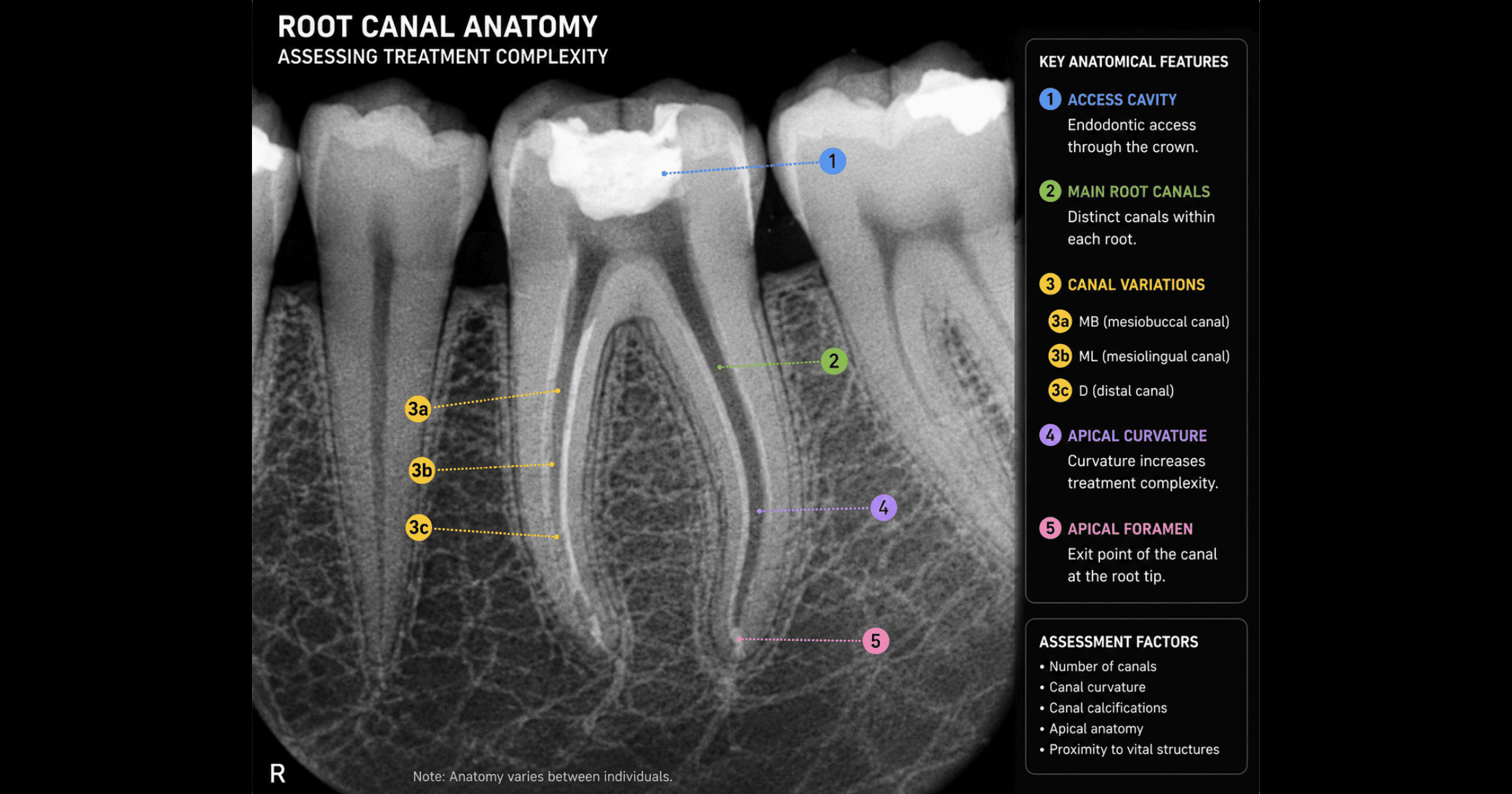 Dental X-ray showing root canal anatomy used to assess treatment complexity