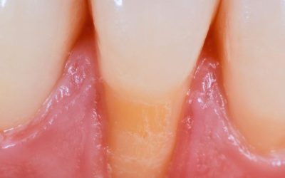 Gum Recession: What Causes It and How It’s Treated
