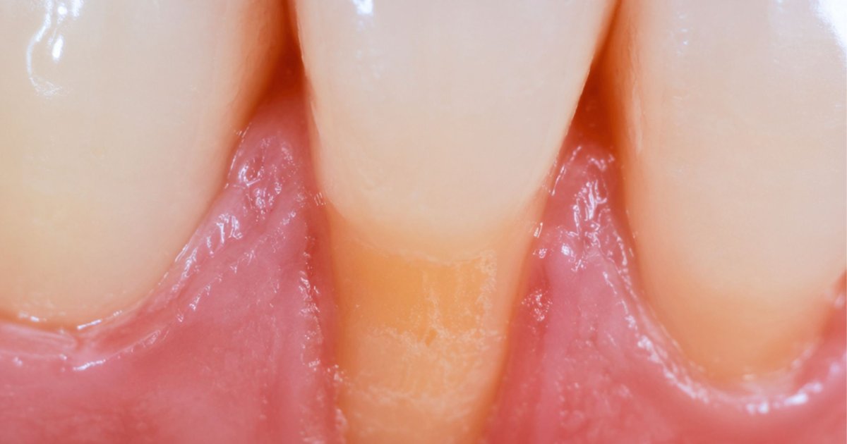 Close-up showing gum recession and exposed tooth root surface in Belmont WA