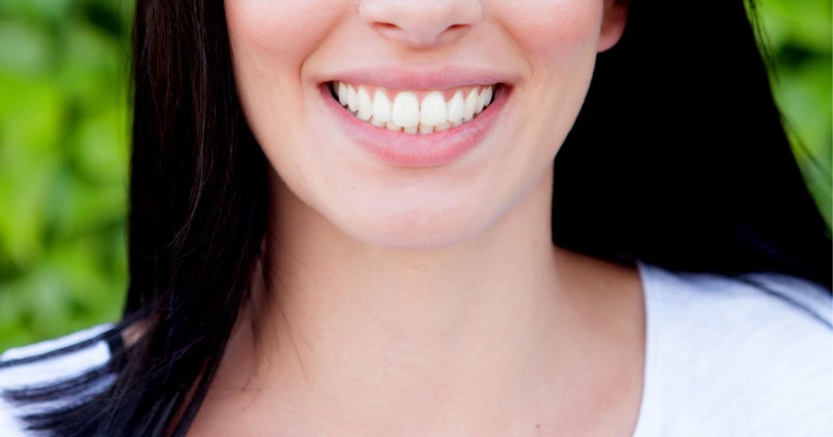 Close-up of a natural smile with dental veneers in Belmont WA