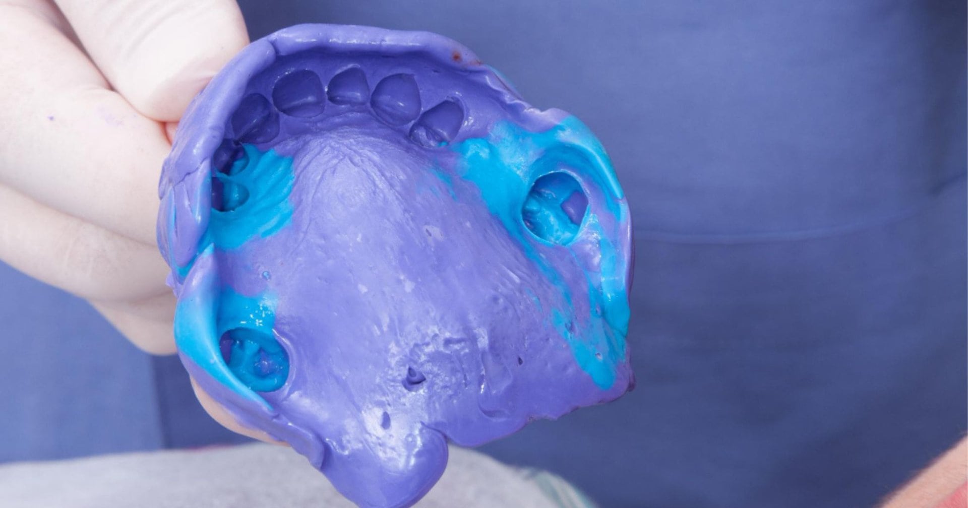 Dental impression mould used for denture fitting in Belmont WA