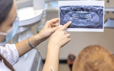 Wisdom Teeth Removal: What to Expect on the Day and How to Recover