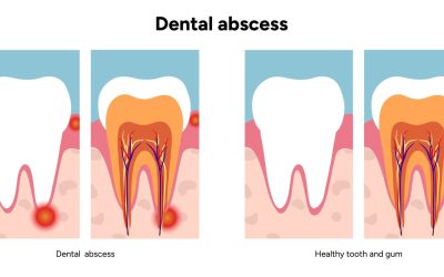 Tooth Abscess Types, Warning Signs and When It’s an Emergency