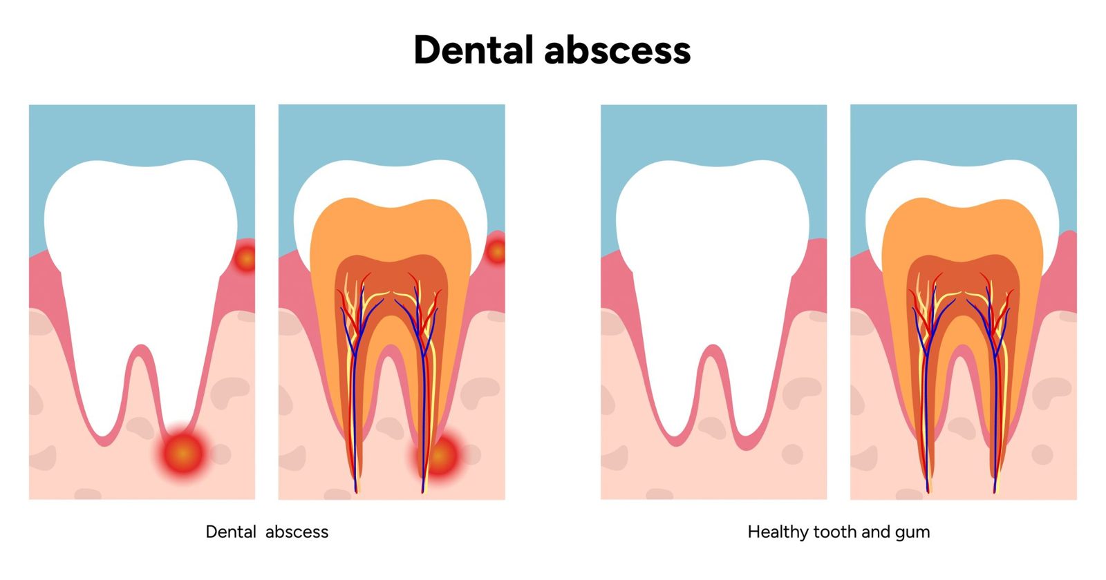 Tooth abscess diagram in Belmont WA